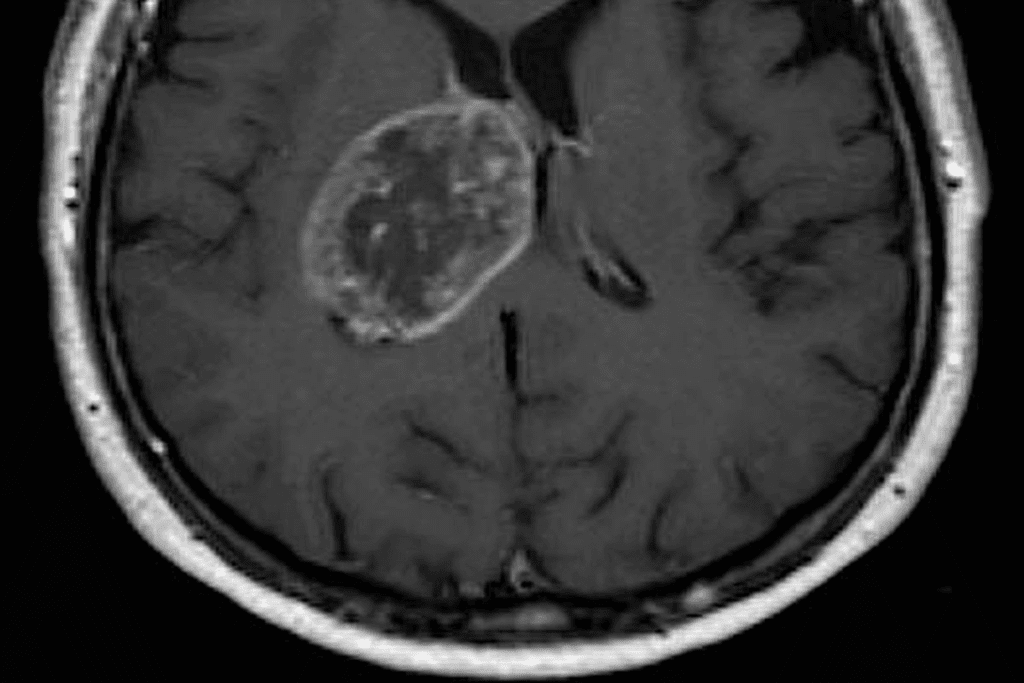MRI Brain Tumor Detection Accuracy
