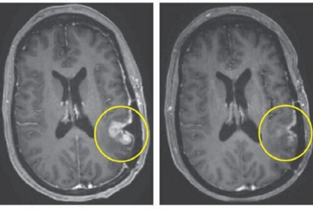 Can Neuroblastoma Disappear: The Amazing Phenomenon