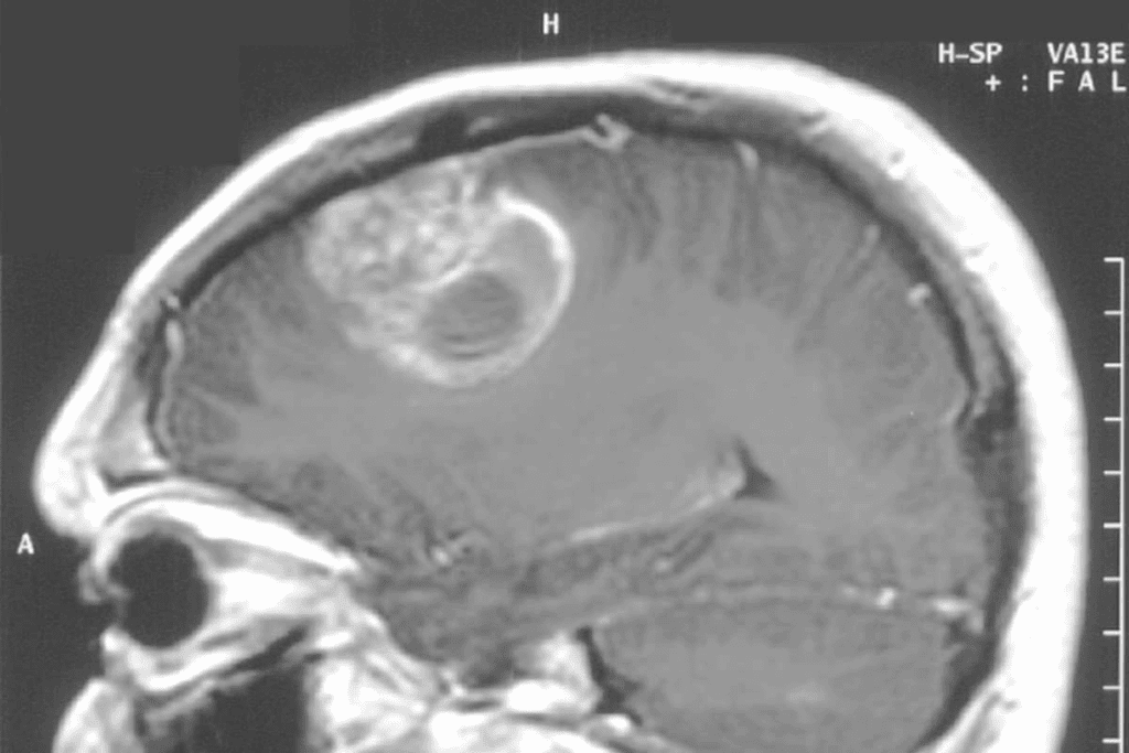 Types of Brain Cancer 2 Types of Brain Cancer