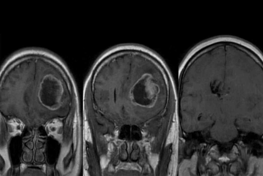CBC Brain Tumor Detection Test