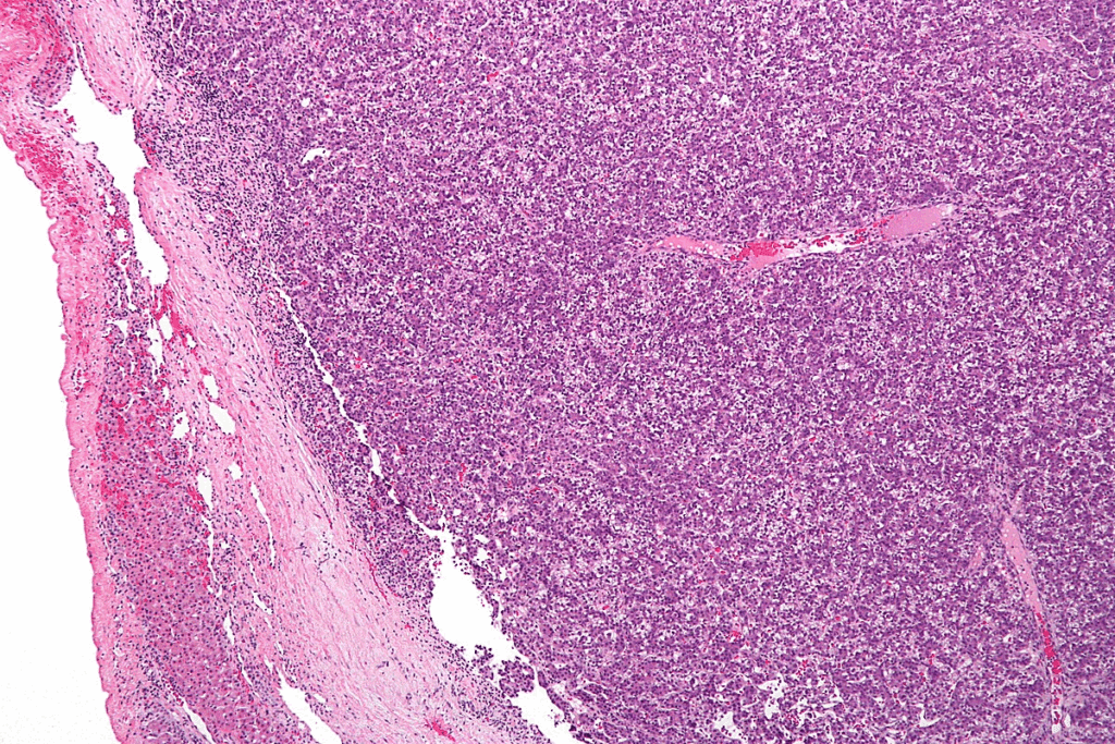 Neuroblastoma Symptoms in Children 2 Neuroblastoma Symptoms in Children