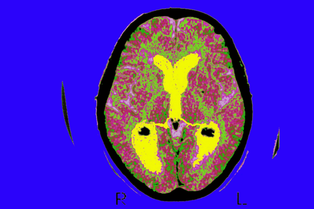 Rhabdomyosarcoma Rare Disease: Critical Facts on Scary Incidence