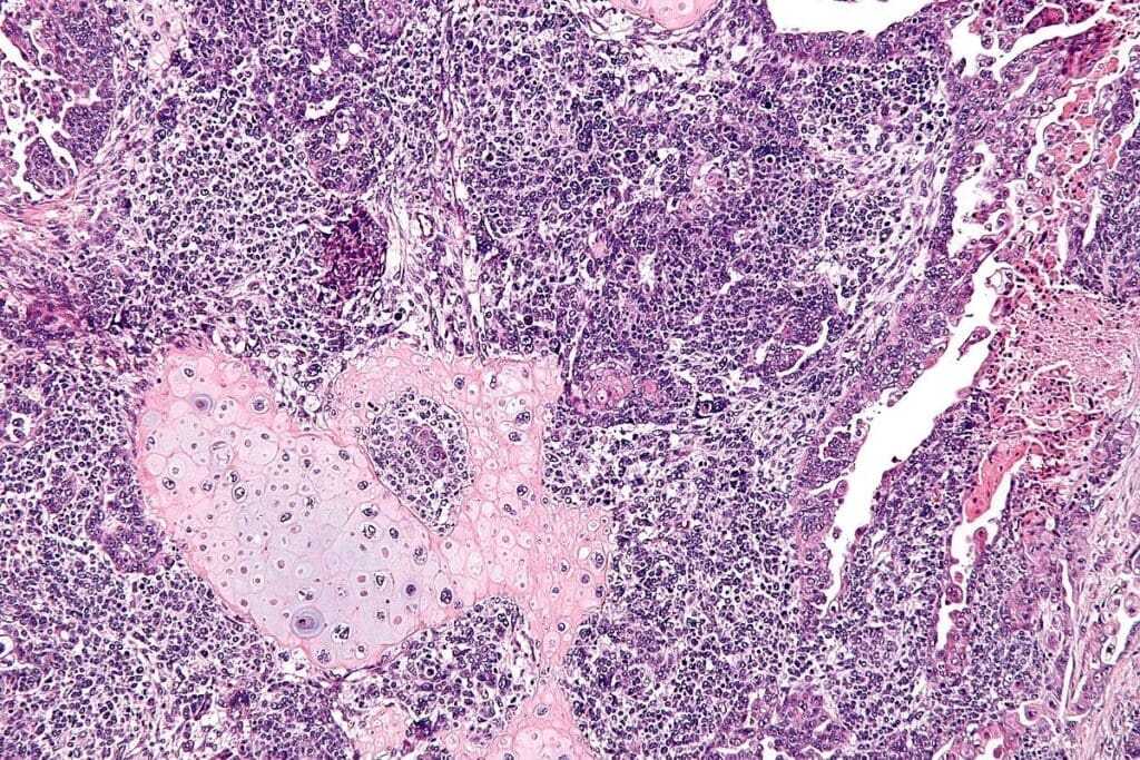 Rhabdomyosarcoma Affected Organs: Key Areas & Vital Spread Info