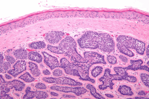 Benign Tumor Characteristics: A Helpful Guide