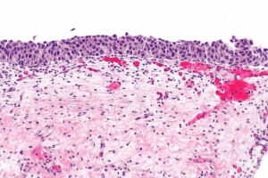 Define In Situ Cancer: Key Differences