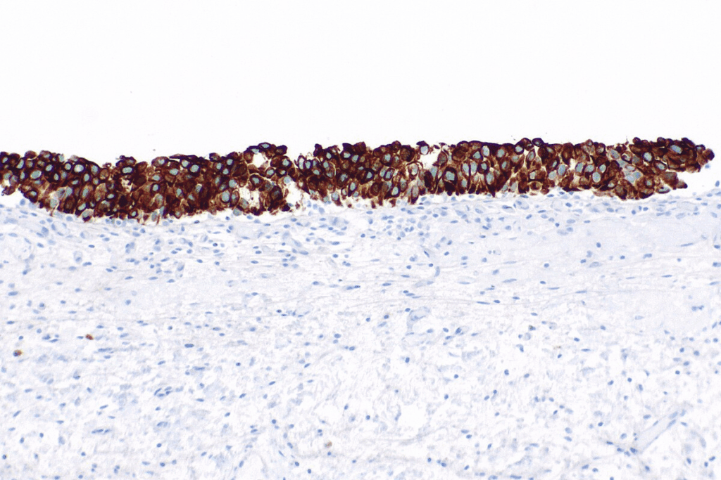 Carcinoma in Situ Bladder Cystoscopy Guide 1 Carcinoma in Situ Bladder Cystoscopy Guide