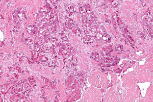 Carcinoma in Situ Bladder: Key CIS Facts