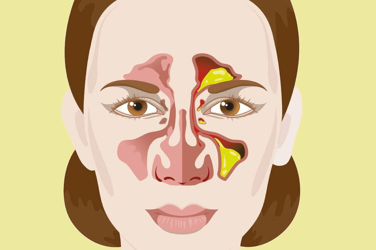 Dry Throat and Nose: Relief for Nasal Passages and Throat 3 Dry Throat and Nose: Relief for Nasal Passages and Throat