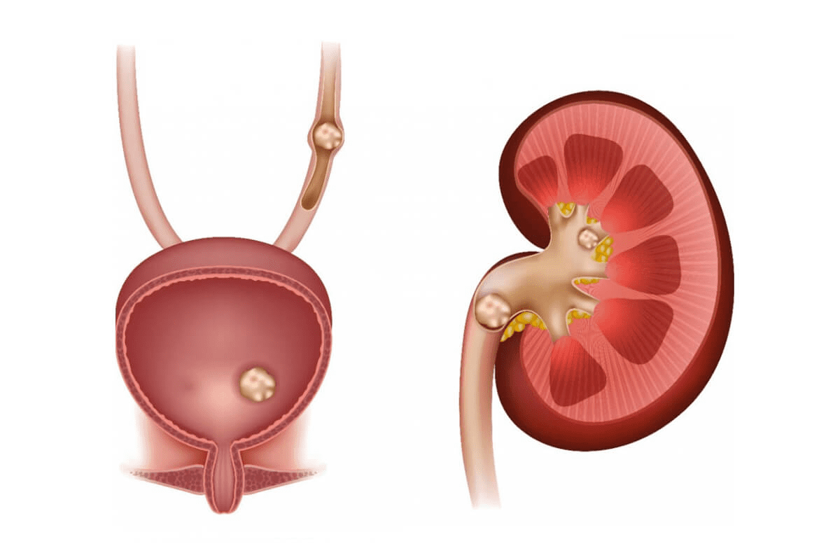 What Do Bladder Stones Feel Like? Symptoms Explained