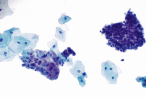 Crystal Urates: Causes and Meaning Explained