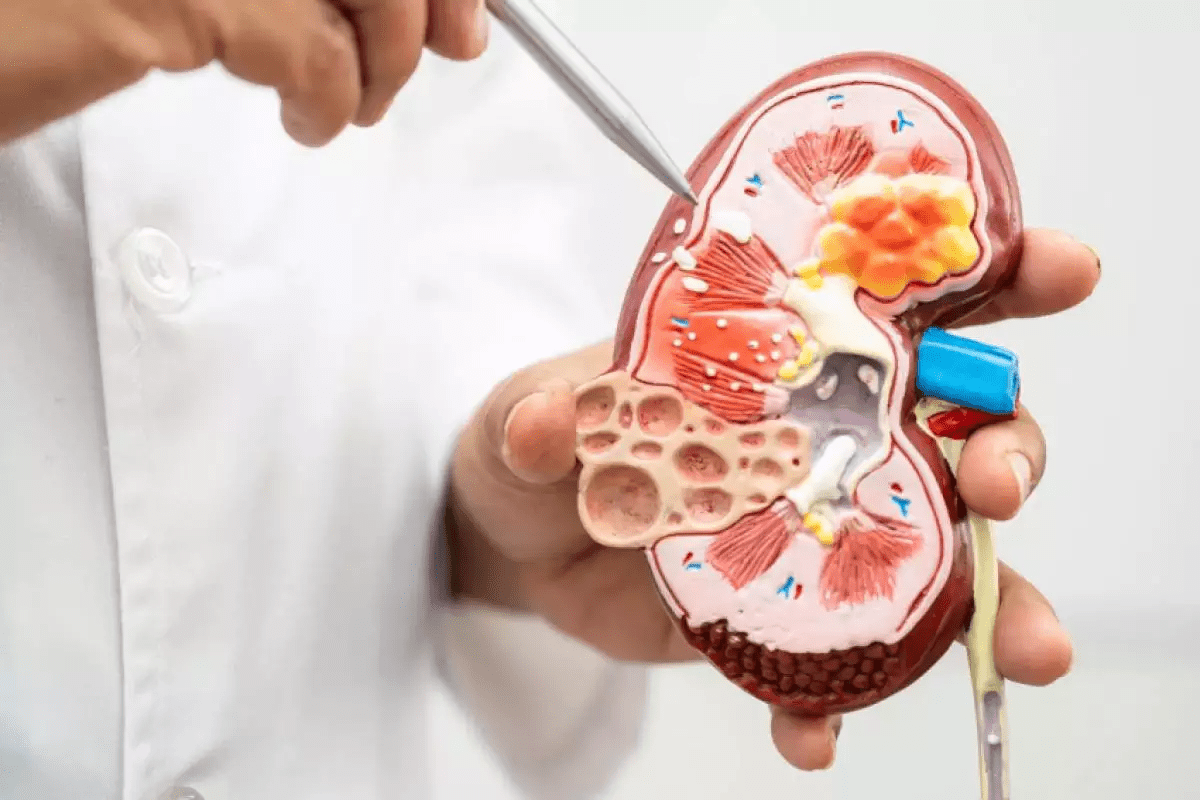 Smooth Kidney Stones: Size, Color & Growth