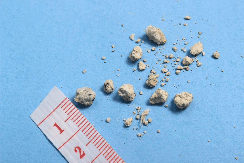 Do Kidney Stones Make Your Urine Smell?