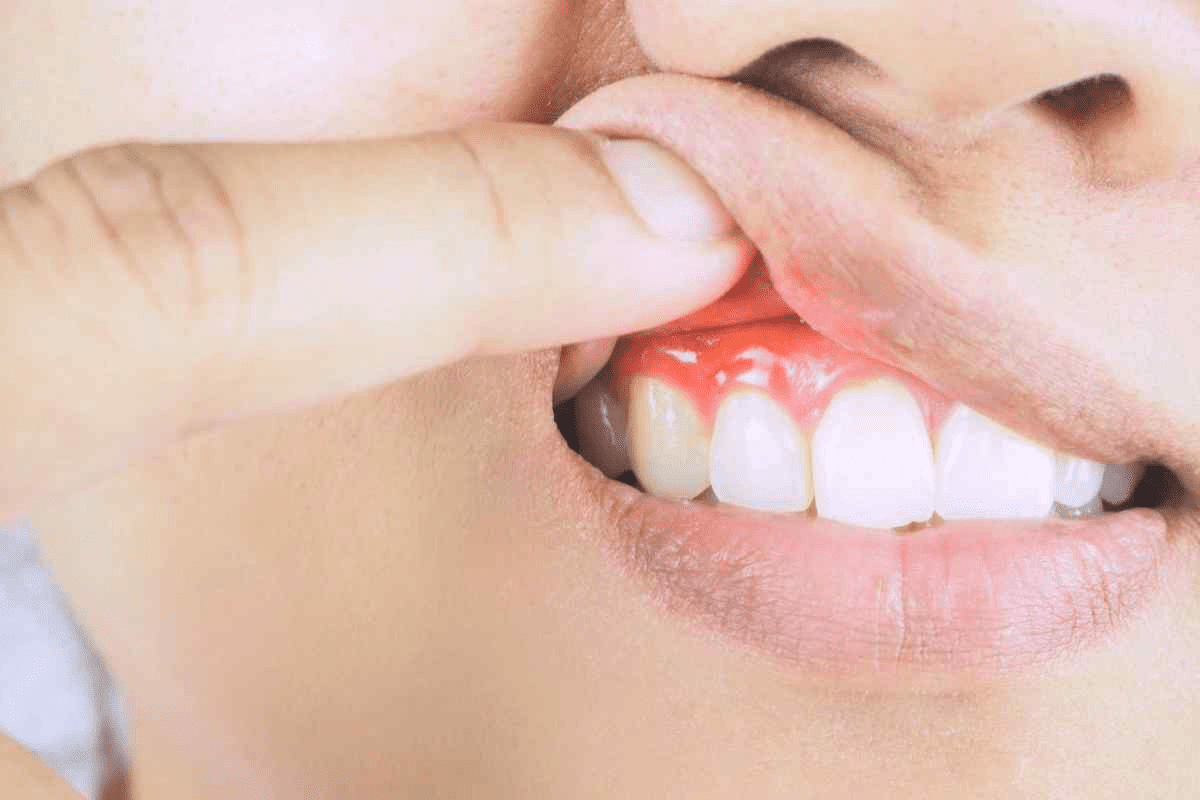 Pharyngitis Disease Causes and Symptoms