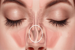 Causes of Nasal Septum Deviation