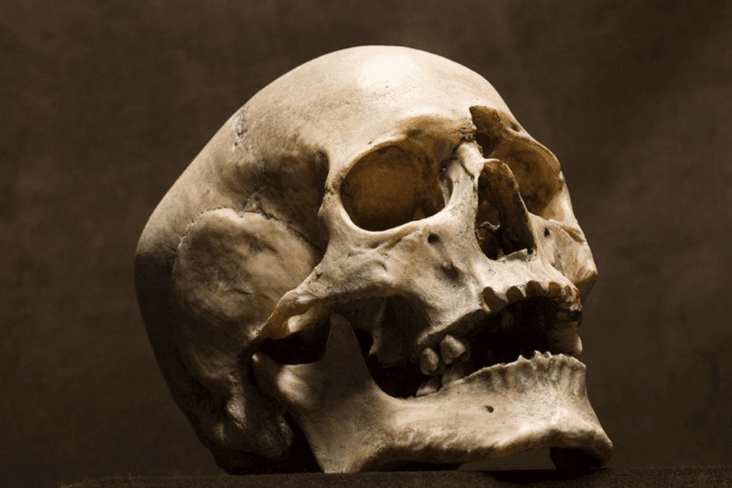 Skull Base Tumor: Causes and Symptoms 1 Skull Base Tumor: Causes and Symptoms