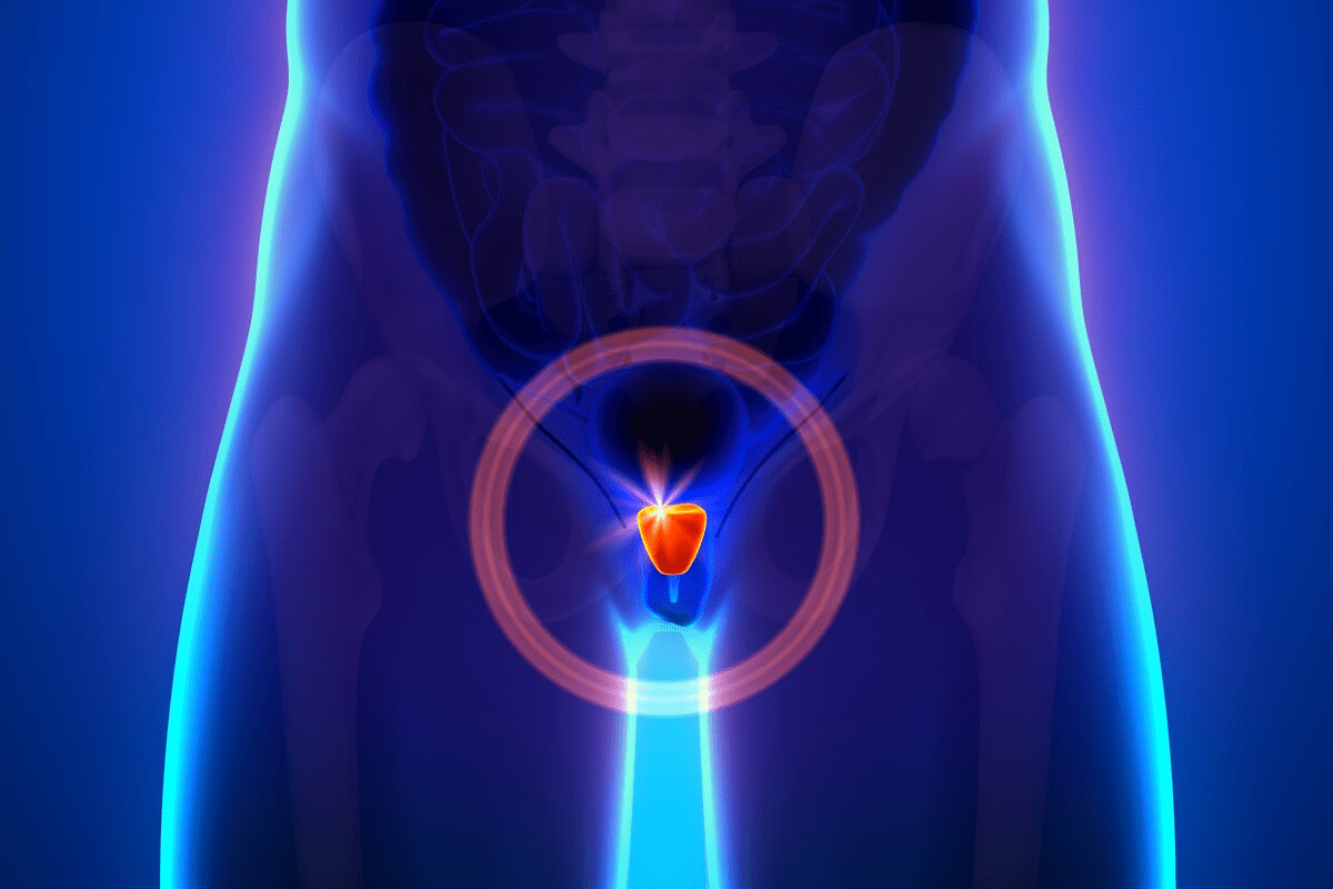 Can Prostate Cancer Cause ED? What You Should Know