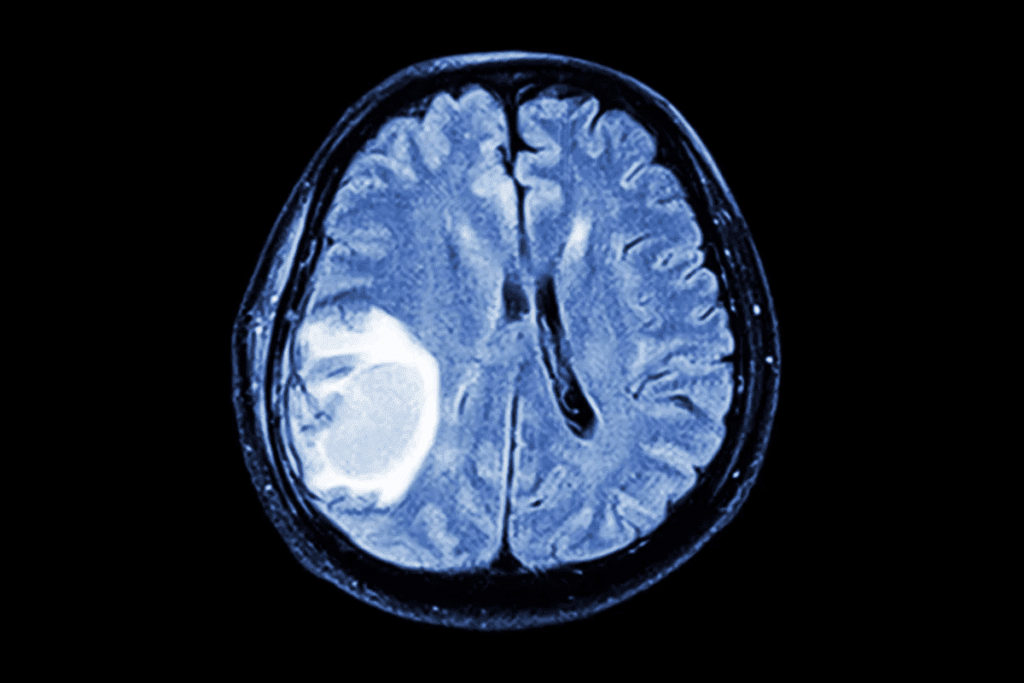 Metastatic Intracranial Tumors: Explained 3 Metastatic Intracranial Tumors: Explained