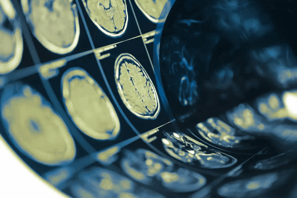 Metastatic Brain Tumor: Growth & Treatment