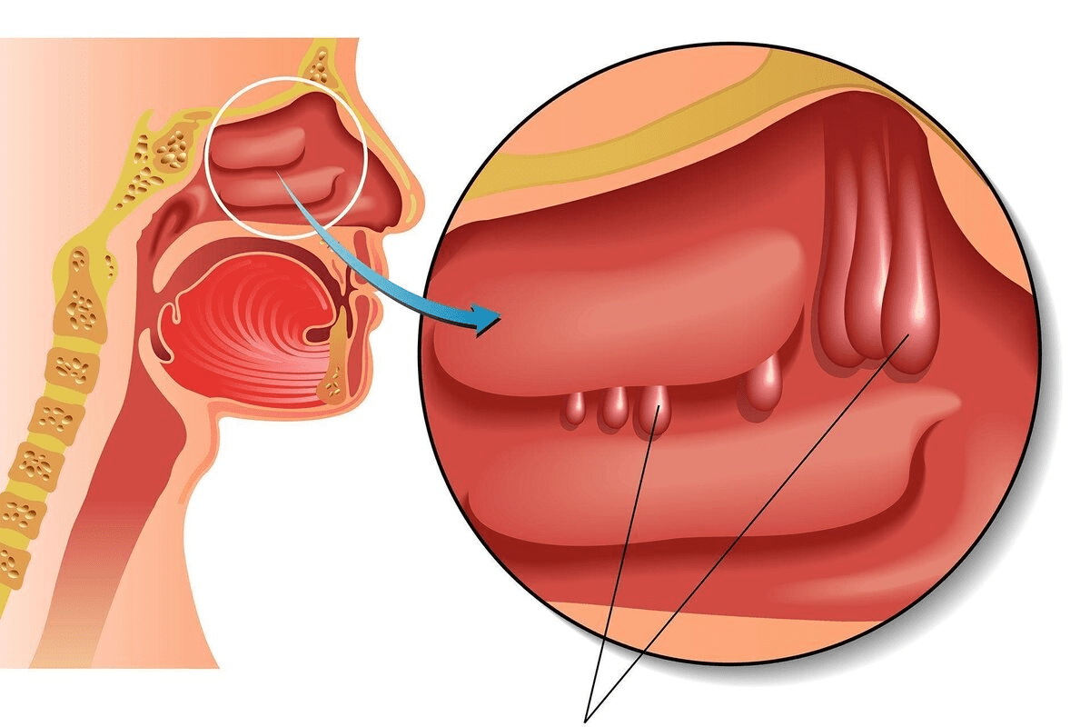 How Long Is Sinusitis Contagious?