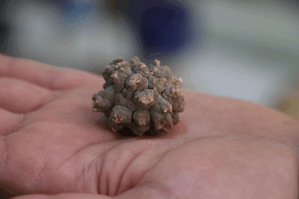 What Color Are Kidney Stones and What Do They Look Like?