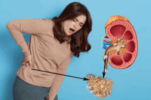 3mm Black Kidney Stones: Prevention