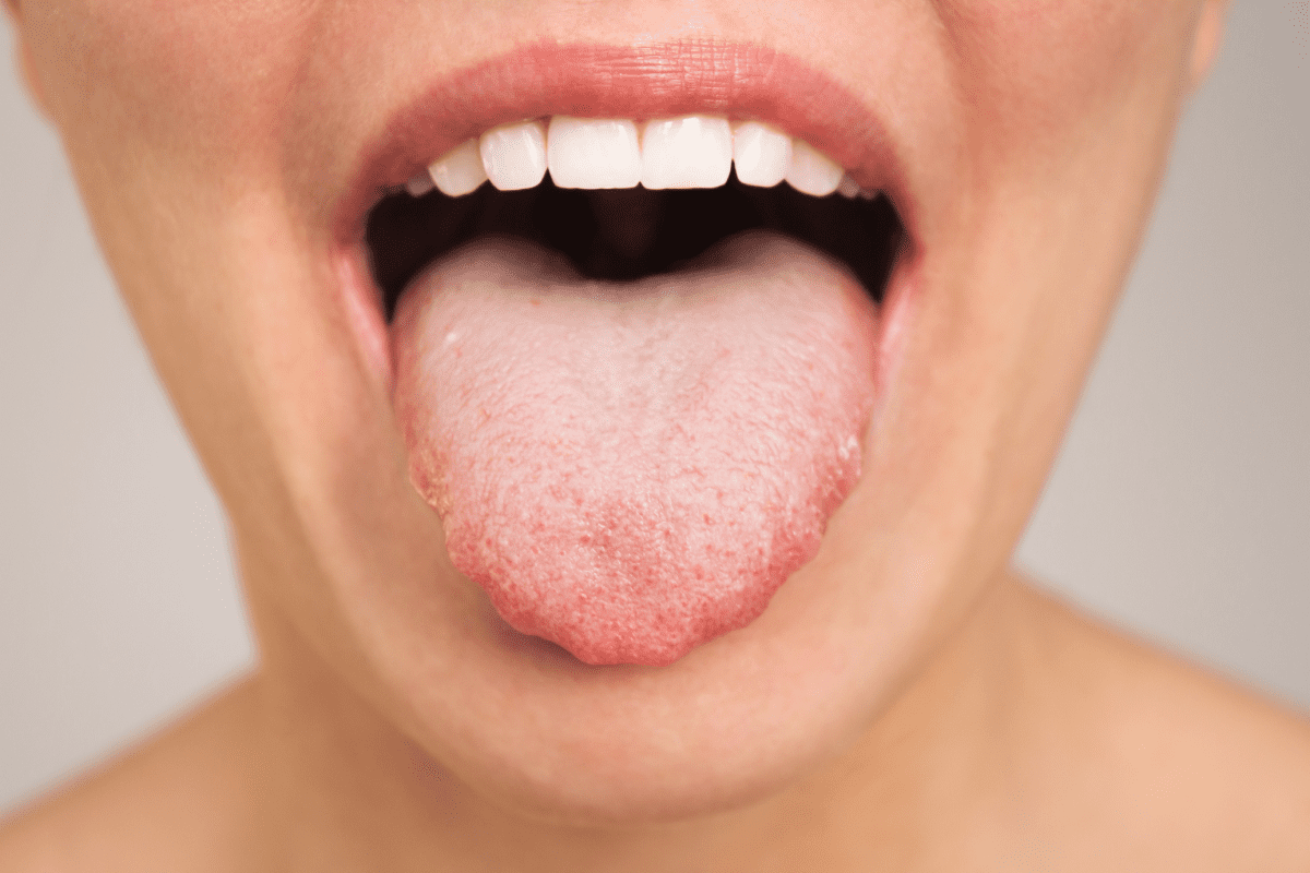 Tongue Cancer Symptoms: Early Signs