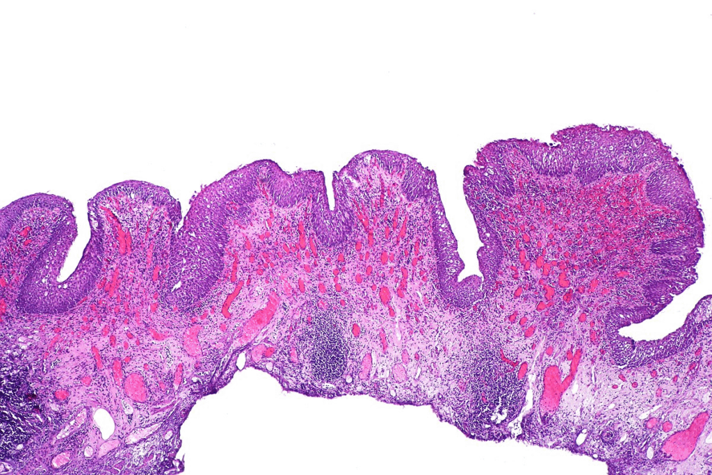 Can You Die From a Bladder Infection ?