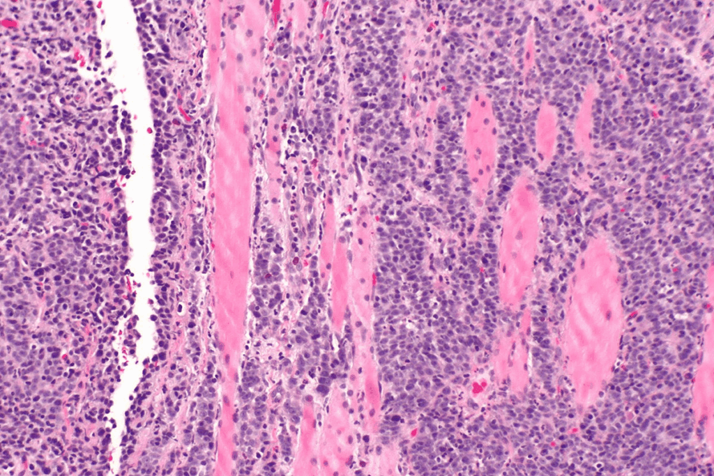 Squamous Cell Skin Cancer on Scalp Facts