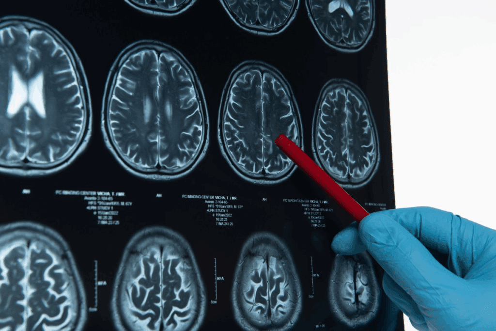 Cancer Spread to Brain: Signs and Treatment