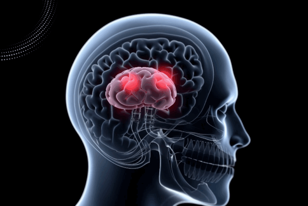 Lung Cancer Mets to Brain: Key Facts 1 Lung Cancer Mets to Brain: Key Facts