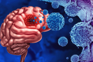 Brain Metastases Symptoms: Early Signsbrain-metastases-symptoms