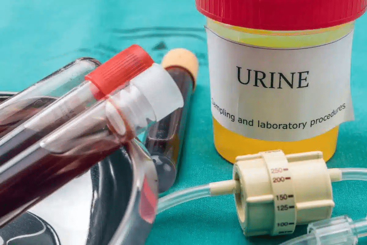 Blood Clots in Urine Male No Pain: Causes & What to Know