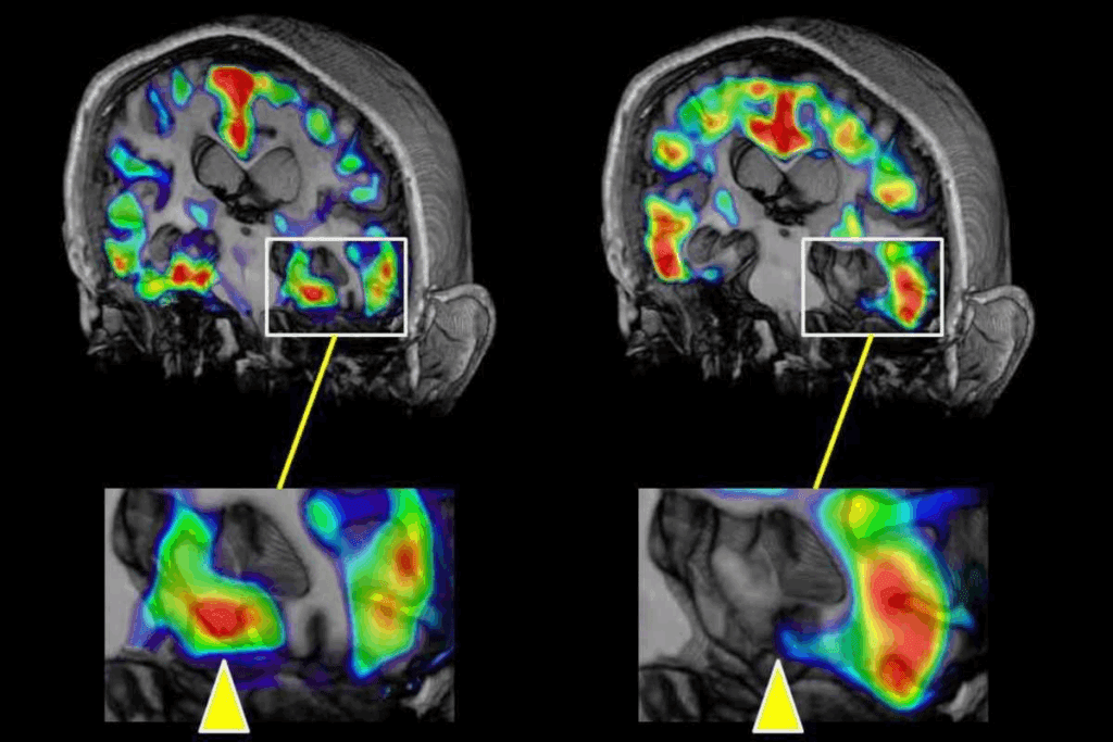 Lesion on Brain: Causes and Recovery 1 Lesion on Brain: Causes and Recovery