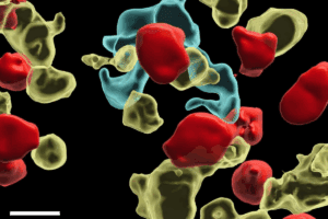 Stage 4 Bladder Cancer: Prognosis and Survival Insights