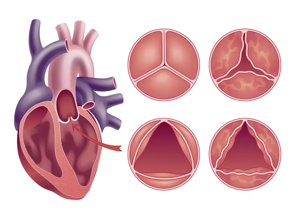 A cross-section of an enlarged, diseased aortic valve, with its characteristic thickened, stiffened, and calcified leaflets. Depicted in a semi-transparent, anatomical style with subtle blue and purple hues, illuminated by soft, directional lighting from the left, creating depth and dimensionality. The valve is set against a muted, monochromatic background, emphasizing the focal point of the pathological condition. The image conveys a sense of clinical precision and scientific understanding, suitable for illustrating the medical topic of aortic valve disease and the need for surgical replacement. A cross-section of an enlarged, diseased aortic valve, with its characteristic thickened, stiffened, and calcified leaflets. Depicted in a semi-transparent, anatomical style with subtle blue and purple hues, illuminated by soft, directional lighting from the left, creating depth and dimensionality. The valve is set against a muted, monochromatic background, emphasizing the focal point of the pathological condition. The image conveys a sense of clinical precision and scientific understanding, suitable for illustrating the medical topic of aortic valve disease and the need for surgical replacement.