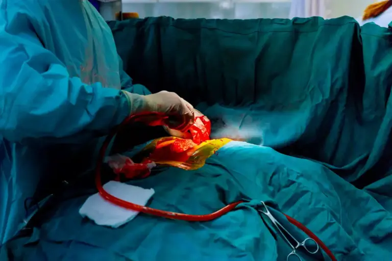 Aortic Valve Replacement: 7 Key Facts About Open Heart Surgery You Must Know