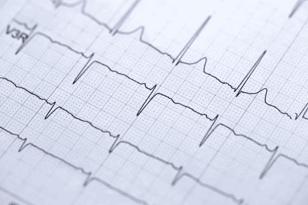 Third Heart Block ECG: 7 Key Features