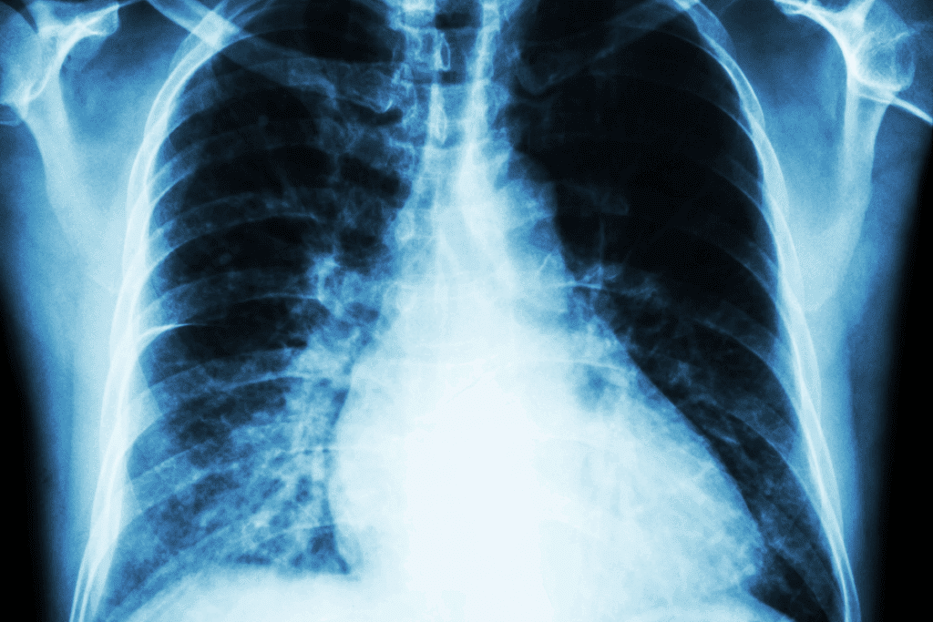 Cardiomegaly Is Most Similar to Cardiac Hypertrophy