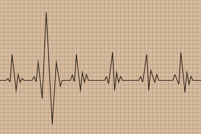 Lethal Arrhythmia: 7 Key Facts to Know