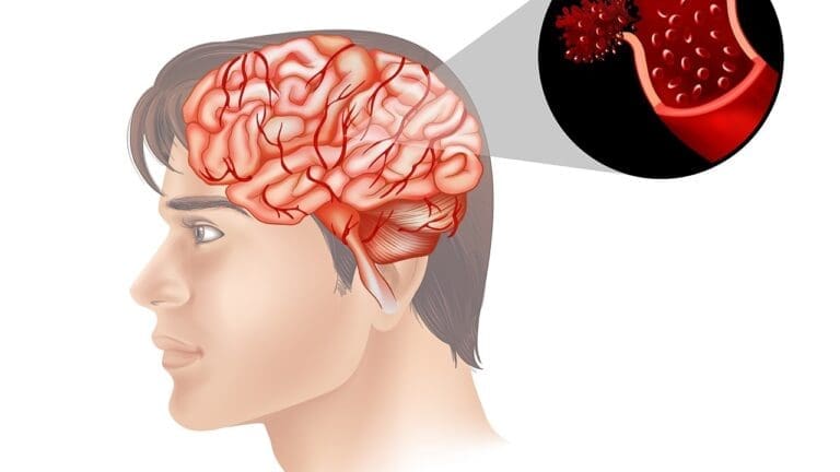 7 Key Facts About Hardening of Arteries in the Brain: Symptoms & Risks