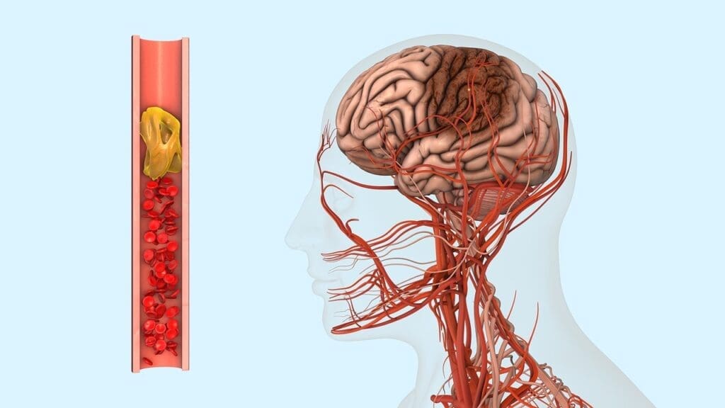 atherosclerosis cerebri