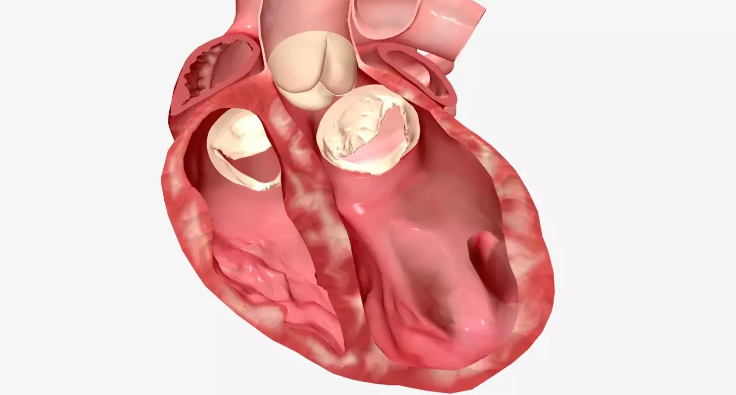How Long Does a Bovine Heart Valve Last After Aortic Valve Replacement?