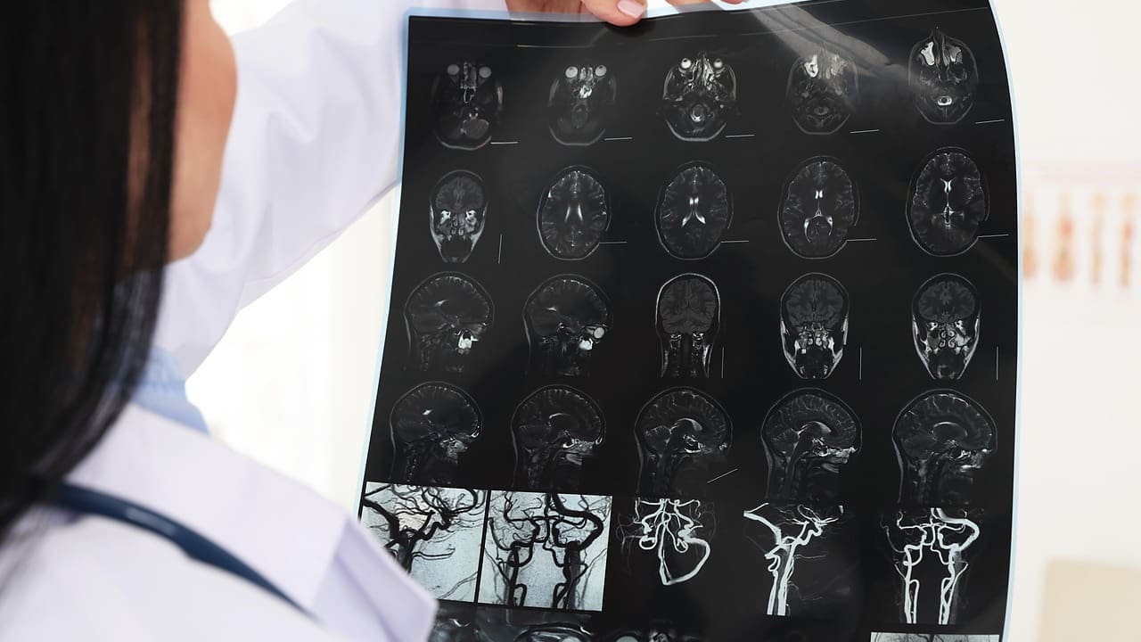 What Does an Aneurysm Look Like on MRI? Key Insights on Saccular and Berry Aneurysms