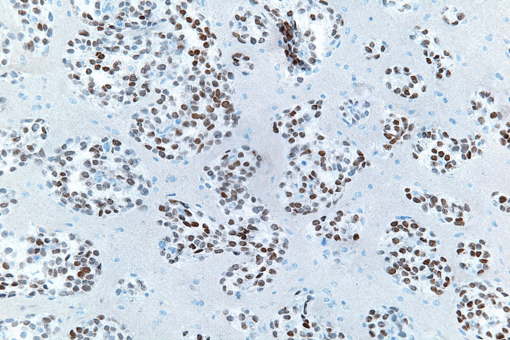 What Causes Plaque Buildup in Arteries: 7 Facts