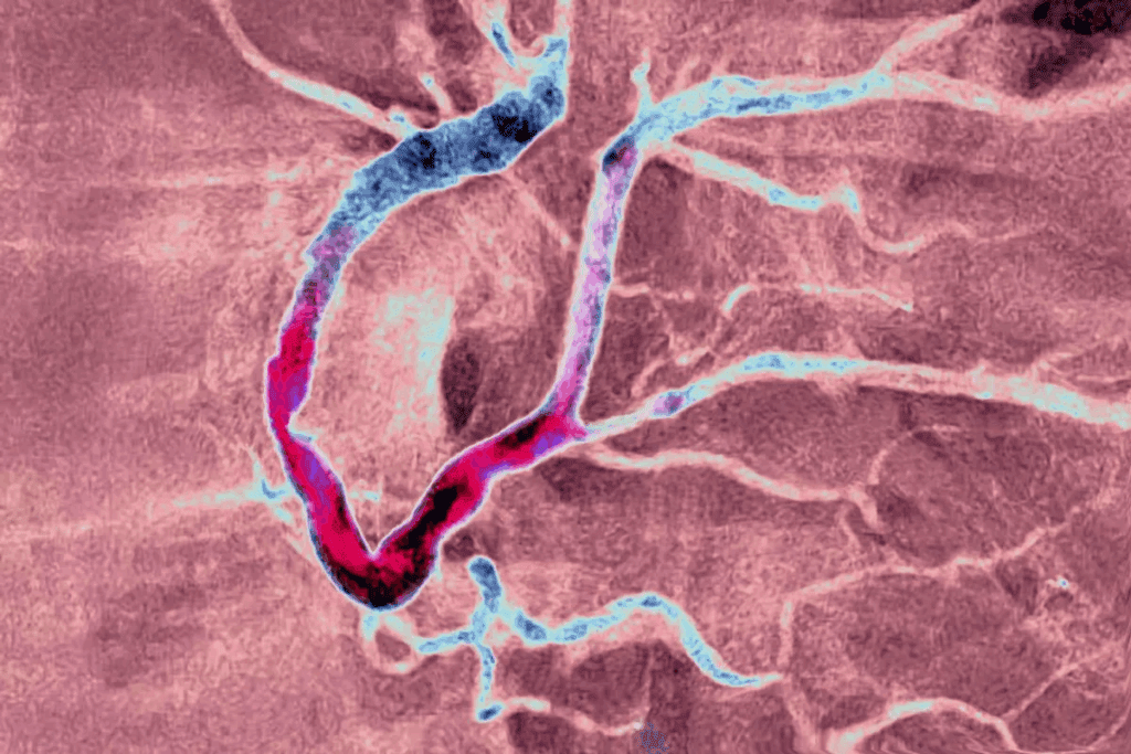 What Is Coronary Artery Disease CAD: 10 Facts 3 What Is Coronary Artery Disease CAD: 10 Facts