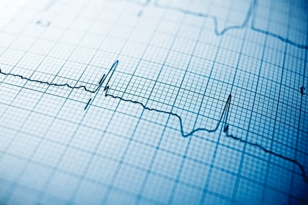 Atrial Tachycardia ECG: 7 Key Features
