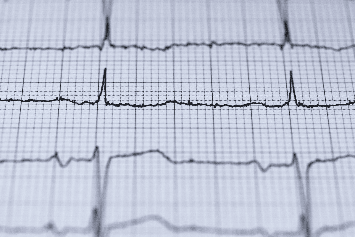 Atrial Tachycardia vs SVT: 7 Key Differences