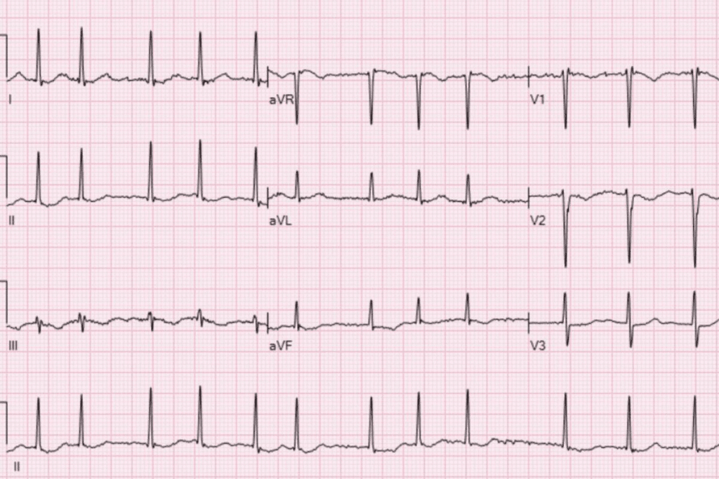 Does a Pacemaker Help AFib? Key Facts 3 Does a Pacemaker Help AFib? Key Facts