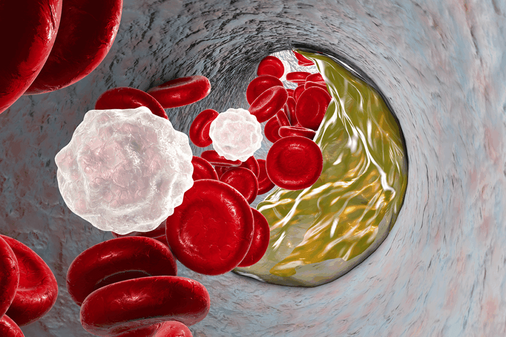 Average Age of Heart Attack in Females: Key Facts 3 Average Age of Heart Attack in Females: Key Facts