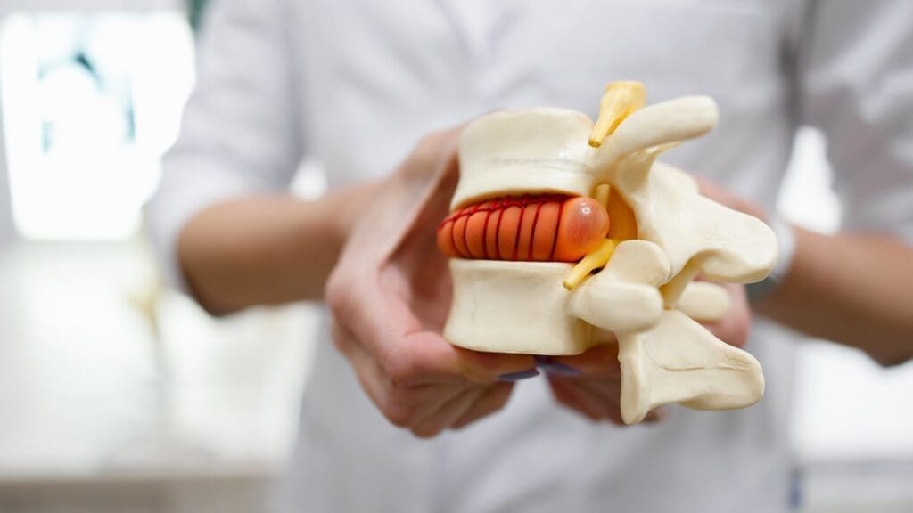 herniated disc diagram herniated disc diagram